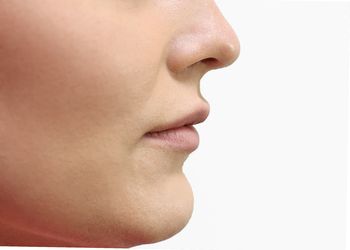 patient after Juvederm filler in lips