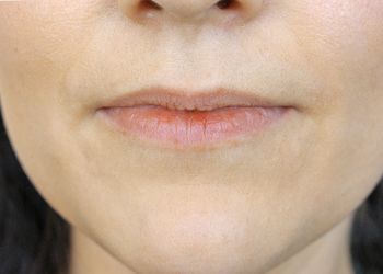 patient before Juvederm filler in lips