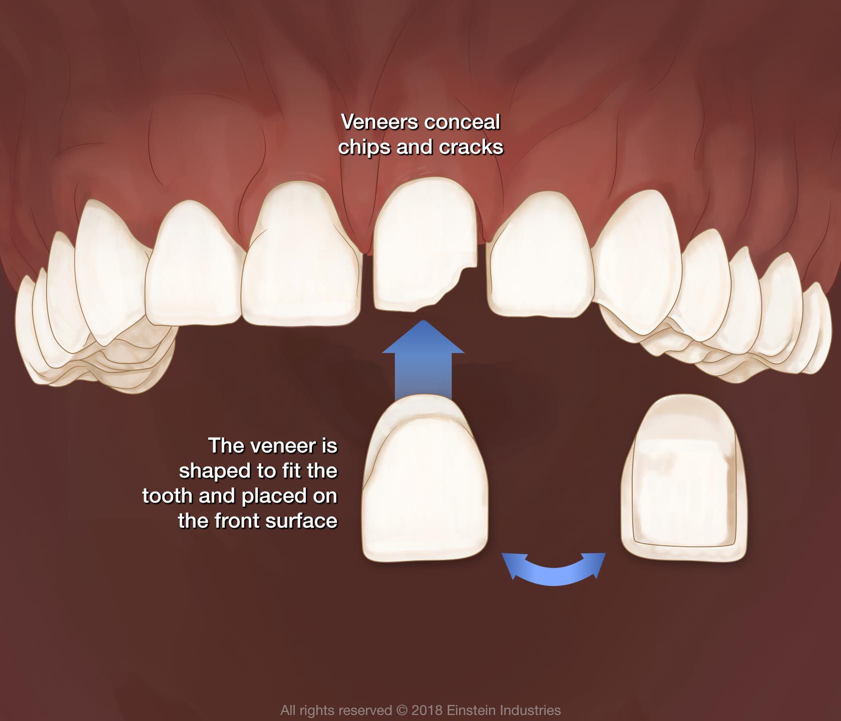 Veneer illustration